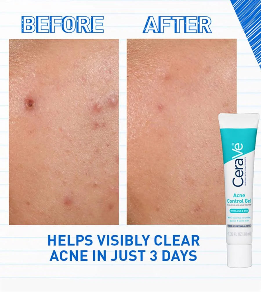 CeraVe Acne Control Gel
